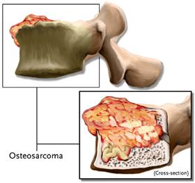 ¿Sabes lo que es el osteosarcoma?