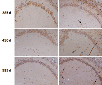 Nuevo indicio de que el Alzheimer es una infección