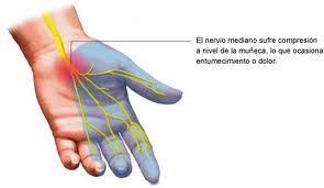 Síndrome del túnel carpiano
