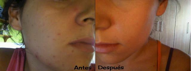 Sebium Serum de Bioderma ¡Mi salvación! Sebium Serum de Bioderma ¡Mi salvación!