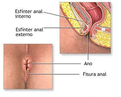 Predicción de los resultados en la cirugía por fístula anal