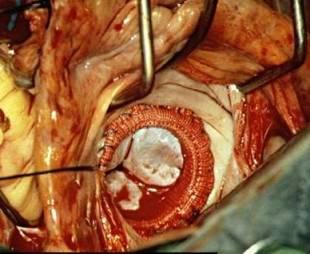 Alto nivel de la cirugía cardíaca en Cuba 20111016055330-3.cirugia-cardiaca.jpg