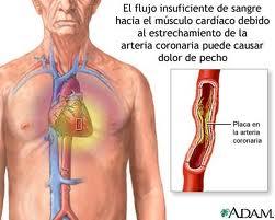 ¿Qué es un preinfarto?