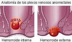 Las Hemorroides