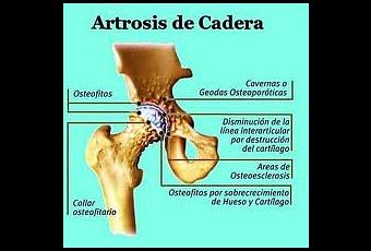 La hernia sheynogo del departamento de la columna vertebral el vértigo