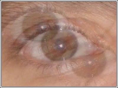 Bécquer y la Otoneurología Bécquer y la Otoneurología