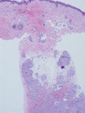 Sarcoidosis subcutanea en una cicatriz de melanoma