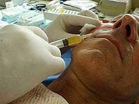 El Lifting Facial Vampírico sistema Selphyl El Lifting Facial Vampírico sistema Selphyl