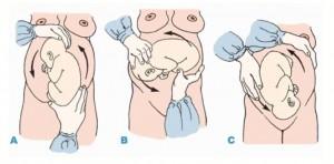 La versión cefálica externa La versión cefálica externa