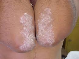 El tratamiento de la psoriasis de la cabeza por el propóleos