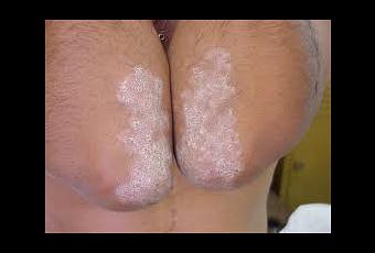 Como curar la psoriasis en las rodillas al niño