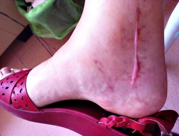 Fibrosuyalgia Fibrosuyalgia