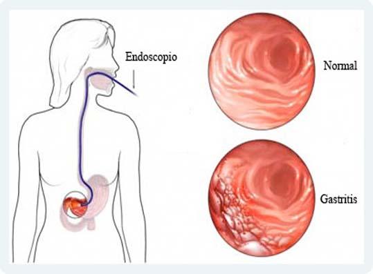 Enfermedades Del Estomago