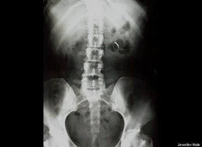 Stuck Up! imágenes de rayos X que muestra cuerpos extraños ingeridos o insertados en el cuerpo humano, por accidente o a propósito (Galería de imágenes) Stuck Up! imágenes de rayos X que muestra cuerpos extraños ingeridos o insertados en el cuerpo humano, por accidente o a propósito (Galería de imágenes)