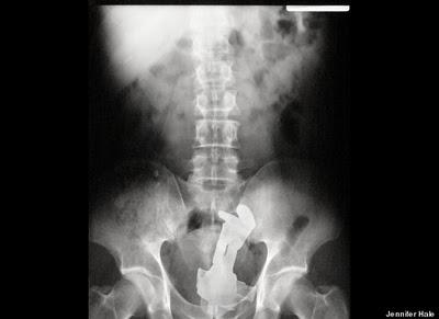 Stuck Up! imágenes de rayos X que muestra cuerpos extraños ingeridos o insertados en el cuerpo humano, por accidente o a propósito (Galería de imágenes) Stuck Up! imágenes de rayos X que muestra cuerpos extraños ingeridos o insertados en el cuerpo humano, por accidente o a propósito (Galería de imágenes)