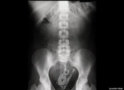 Stuck Up! imágenes de rayos X que muestra cuerpos extraños ingeridos o insertados en el cuerpo humano, por accidente o a propósito (Galería de imágenes) Stuck Up! imágenes de rayos X que muestra cuerpos extraños ingeridos o insertados en el cuerpo humano, por accidente o a propósito (Galería de imágenes)