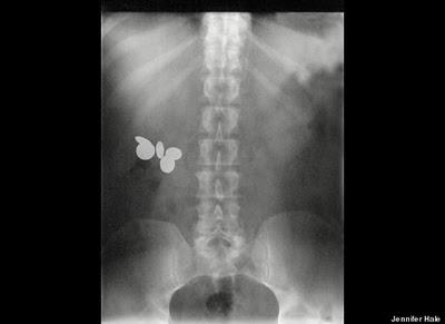 Stuck Up! imágenes de rayos X que muestra cuerpos extraños ingeridos o insertados en el cuerpo humano, por accidente o a propósito (Galería de imágenes) Stuck Up! imágenes de rayos X que muestra cuerpos extraños ingeridos o insertados en el cuerpo humano, por accidente o a propósito (Galería de imágenes)