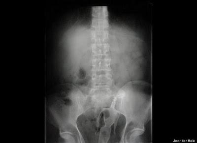 Stuck Up! imágenes de rayos X que muestra cuerpos extraños ingeridos o insertados en el cuerpo humano, por accidente o a propósito (Galería de imágenes) Stuck Up! imágenes de rayos X que muestra cuerpos extraños ingeridos o insertados en el cuerpo humano, por accidente o a propósito (Galería de imágenes)
