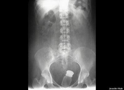 Stuck Up! imágenes de rayos X que muestra cuerpos extraños ingeridos o insertados en el cuerpo humano, por accidente o a propósito (Galería de imágenes) Stuck Up! imágenes de rayos X que muestra cuerpos extraños ingeridos o insertados en el cuerpo humano, por accidente o a propósito (Galería de imágenes)