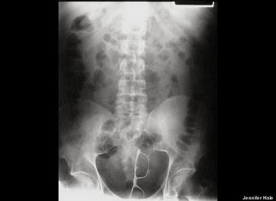 Stuck Up! imágenes de rayos X que muestra cuerpos extraños ingeridos o insertados en el cuerpo humano, por accidente o a propósito (Galería de imágenes) Stuck Up! imágenes de rayos X que muestra cuerpos extraños ingeridos o insertados en el cuerpo humano, por accidente o a propósito (Galería de imágenes)