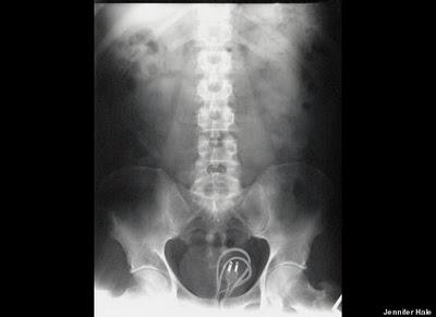 Stuck Up! imágenes de rayos X que muestra cuerpos extraños ingeridos o insertados en el cuerpo humano, por accidente o a propósito (Galería de imágenes) Stuck Up! imágenes de rayos X que muestra cuerpos extraños ingeridos o insertados en el cuerpo humano, por accidente o a propósito (Galería de imágenes)