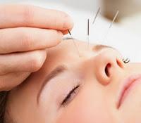 Hallan que la acupuntura es segura para los niños Hallan que la acupuntura es segura para los niños