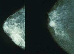 Normal (left) versus cancerous (right) mammogr...