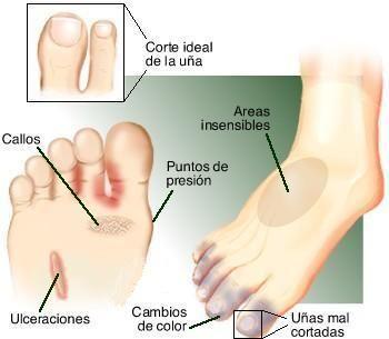Cómo prevenir el pie diabético Cómo prevenir el pie diabético