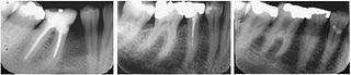 Las radiografías dentales podrían predecir fracturas óseas futuras Las radiografías dentales podrían predecir fracturas óseas futuras