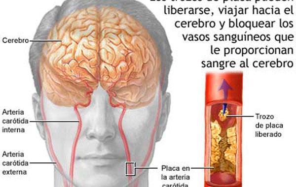 Los sintomas 'silenciosos' del derrame cerebral.