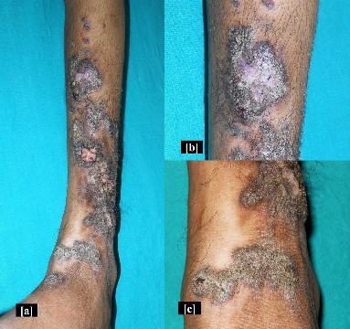 Angioqueratoma circunscripto neviforme Angioqueratoma circunscripto neviforme