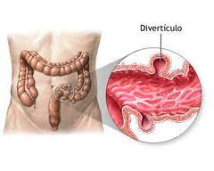 diverticulosis ¿Qué es la Diverticulosis?