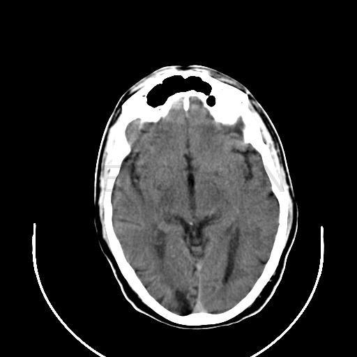 Estenosis arterial intracraneal Estenosis arterial intracraneal