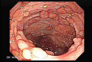 El cáncer colorrectal ocupa el segundo lugar después del cáncer de mama