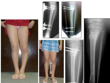 Tratamiento de las fracturas Graves