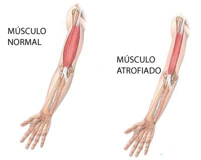 distrofia muscular ¿Qué son las distrofias musculares?