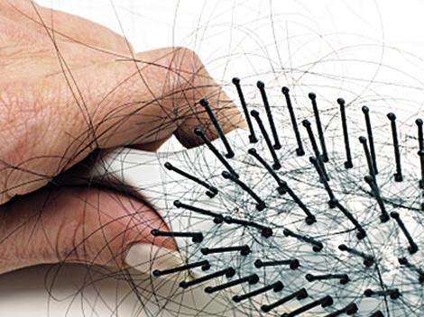 perdida-cabello GANANCIAS Y PERDIDAS