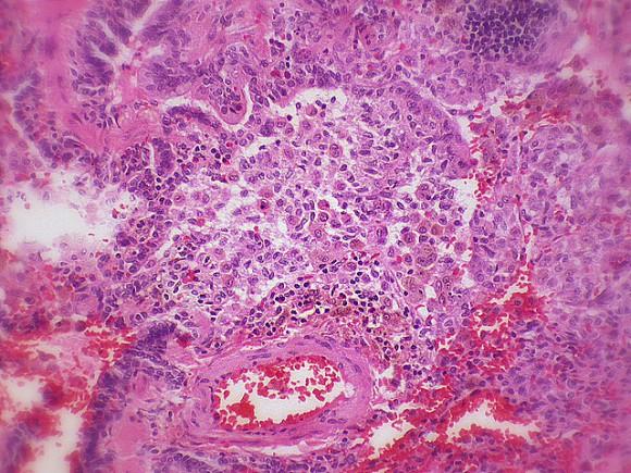 Bronquiolitis Bronquiolitis