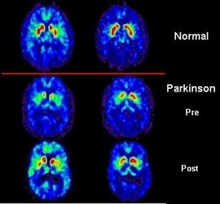 El trastorno del sueño y la depresión, primeros síntomas del Parkinson
