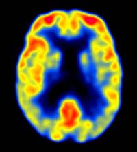 Predecir el declive cognitivo mediante PET Predecir el declive cognitivo mediante PET