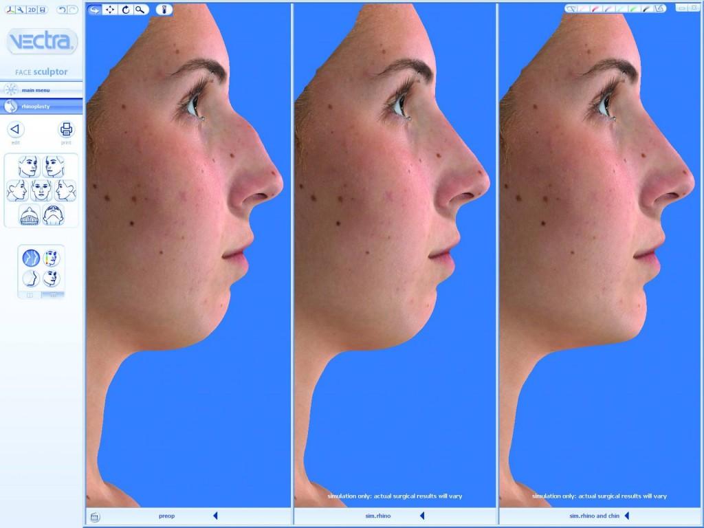 Dr Paloma-Pre_rhino CONOZCO TU CARA