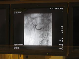 El Hospital Regional de Málaga implanta una nueva técnica para el tratamiento de pacientes con HTA resistente a fármacos El Hospital Regional de Málaga implanta una nueva técnica para el tratamiento de pacientes con HTA resistente a fármacos