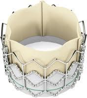 Válvula aórtica artificial que no necesita cirugía a corazón abierto Válvula aórtica artificial que no necesita cirugía a corazón abierto