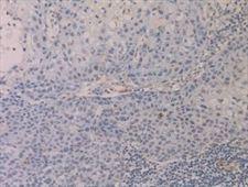 Investigadores del IDIBELL identifican una proteína implicada en el inicio de la metástasis Investigadores del IDIBELL identifican una proteína implicada en el inicio de la metástasis