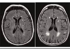 Lesiones de la materia blanca cerebral estarían asociadas a ACV y demencia