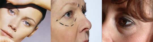 blefaroplastia blefaroplastia