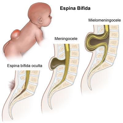 espina-bifida espina bifida ¿Que es la Espina bífida?