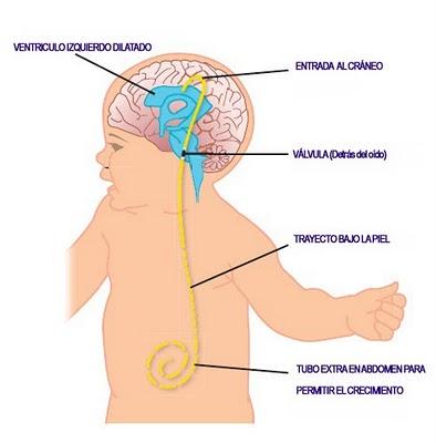 Derivación Ventrículo - Peritoneal