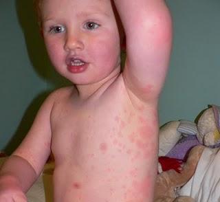 Niño celiaco envenedado-Celiac child poisoned Niño celiaco envenedado-Celiac child poisoned