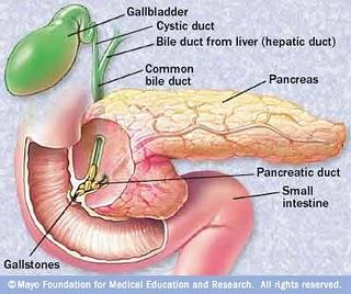 ¿Qué es...?: La pancreatitis aguda